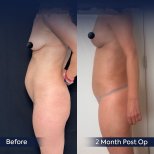 Vorher-nachher-Ergebnis Bauchdeckenstraffung bei Dr. Safa Manav Clinic, flacherer Bauch