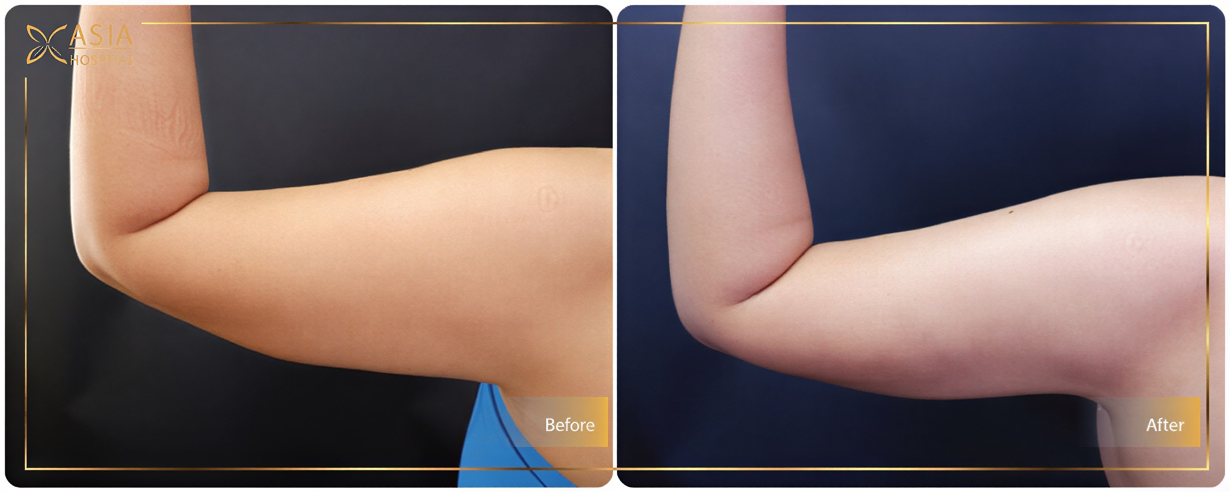 نتائج شفط دهون الذراع قبل وبعد في Asia Cosmetic Hospital، تحسين شكل الذراع