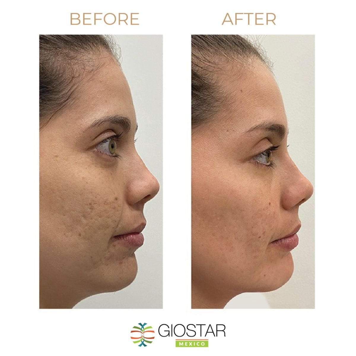 Antes y después de terapia con células madre para rejuvenecimiento facial en Giostar Cancun Clinic
