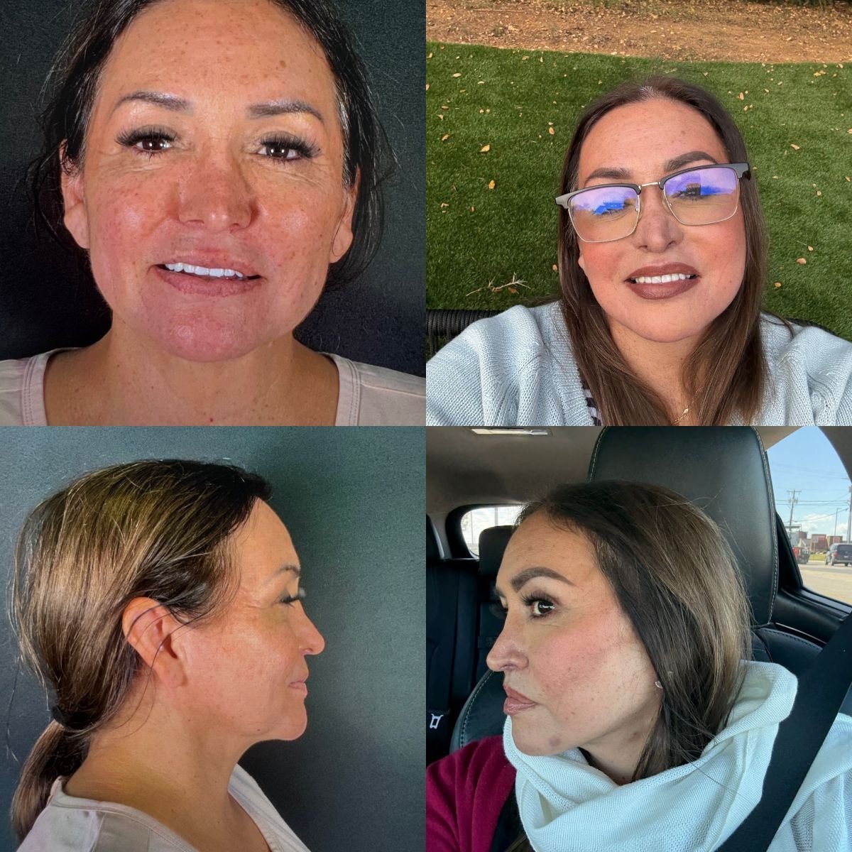 Результати до і після deep plane підтяжки обличчя в клініці Marroquín & Sandoval