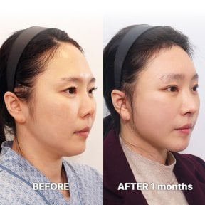 Resultados de lifting facial antes y después en Returning Plastic Surgery, mejora del contorno