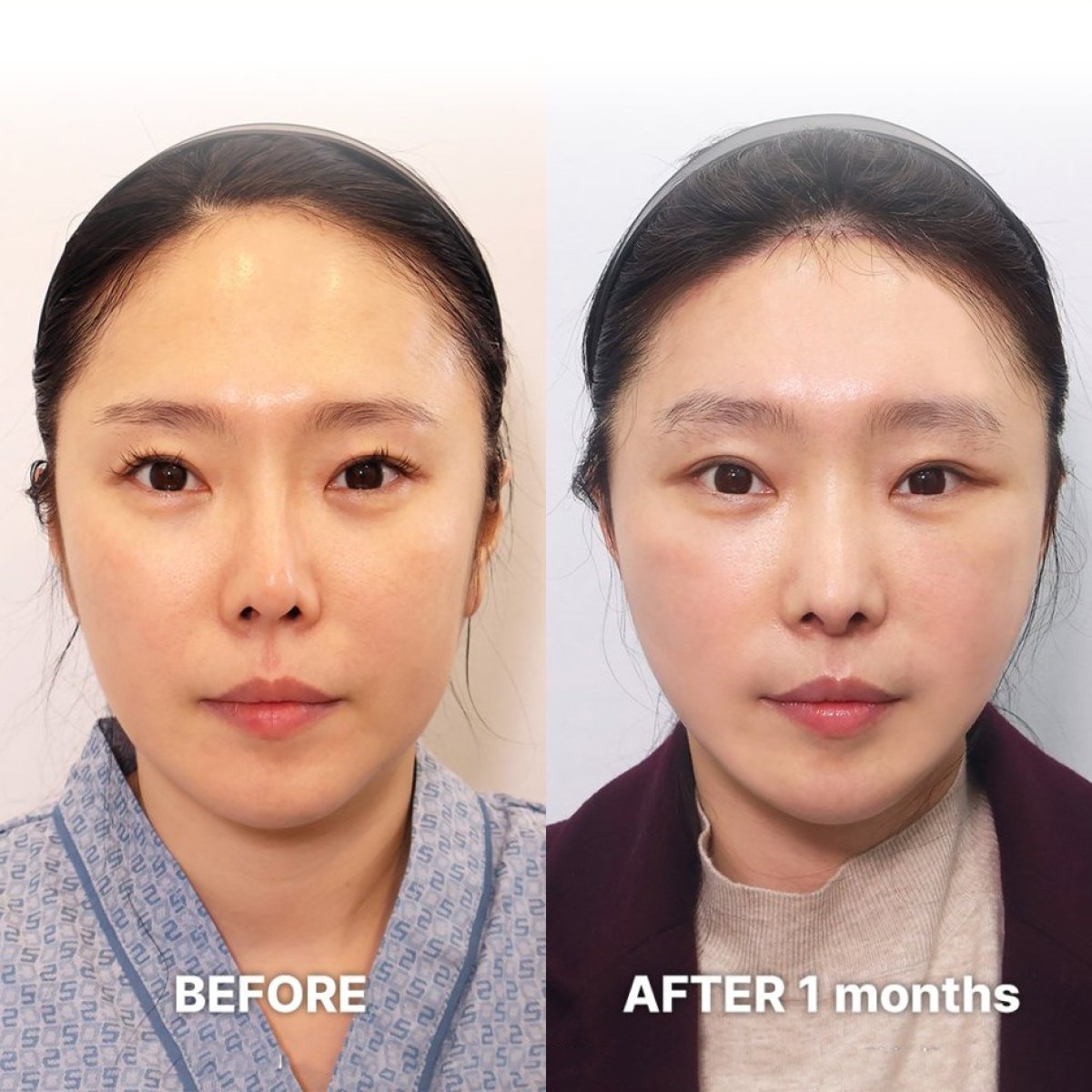 Facelift Vorher-Nachher-Ergebnisse bei Returning Plastic Surgery, sichtbare Verjüngung
