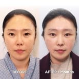 Resultados de lifting facial antes y después en Returning Plastic Surgery, rejuvenecimiento