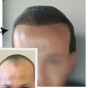 Vorher-nachher-Ergebnisse der Haartransplantation im Medical Park Antalya Hospital Complex, vollere Haarlinie