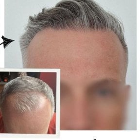 Vorher-nachher-Ergebnis der Haartransplantation im Medical Park Antalya Hospital Complex, vollere Haarlinie