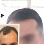 Vorher-nachher-Ergebnis Haartransplantation bei Medical Park Antalya Hospital Complex, Haaransatz wiederhergestellt