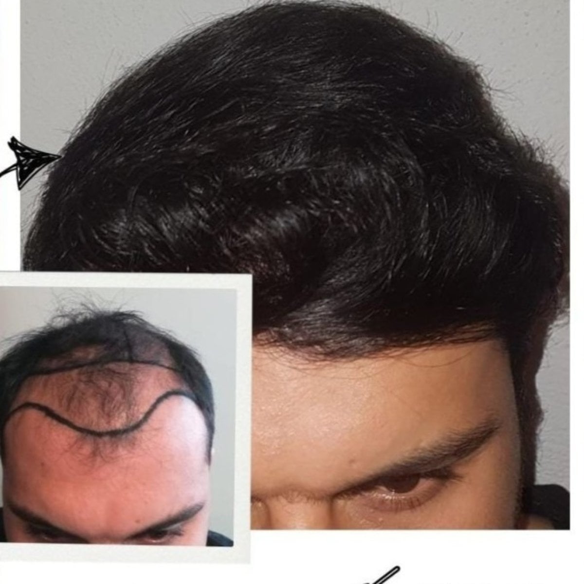 نتائج زراعة الشعر قبل وبعد في مجمع ميديكال بارك أنطاليا، خط شعر أكثر كثافة