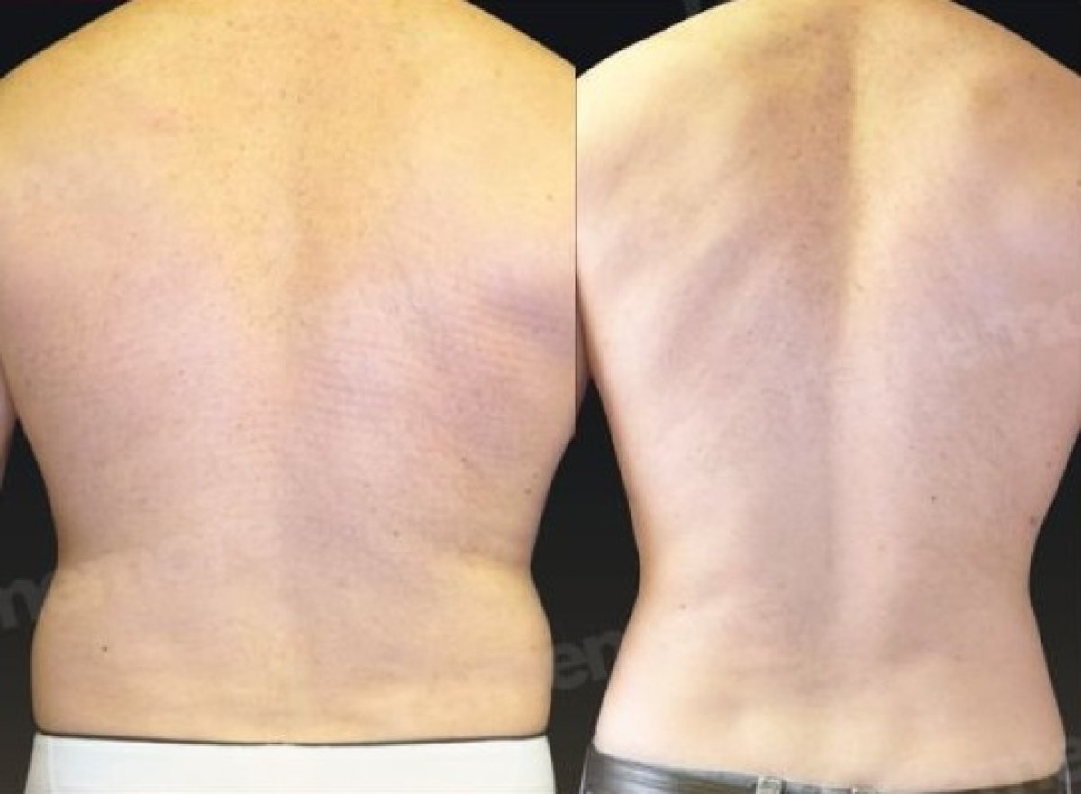 Before and after 360 liposuction results at Memorial Şişli Hospital, improved back contour