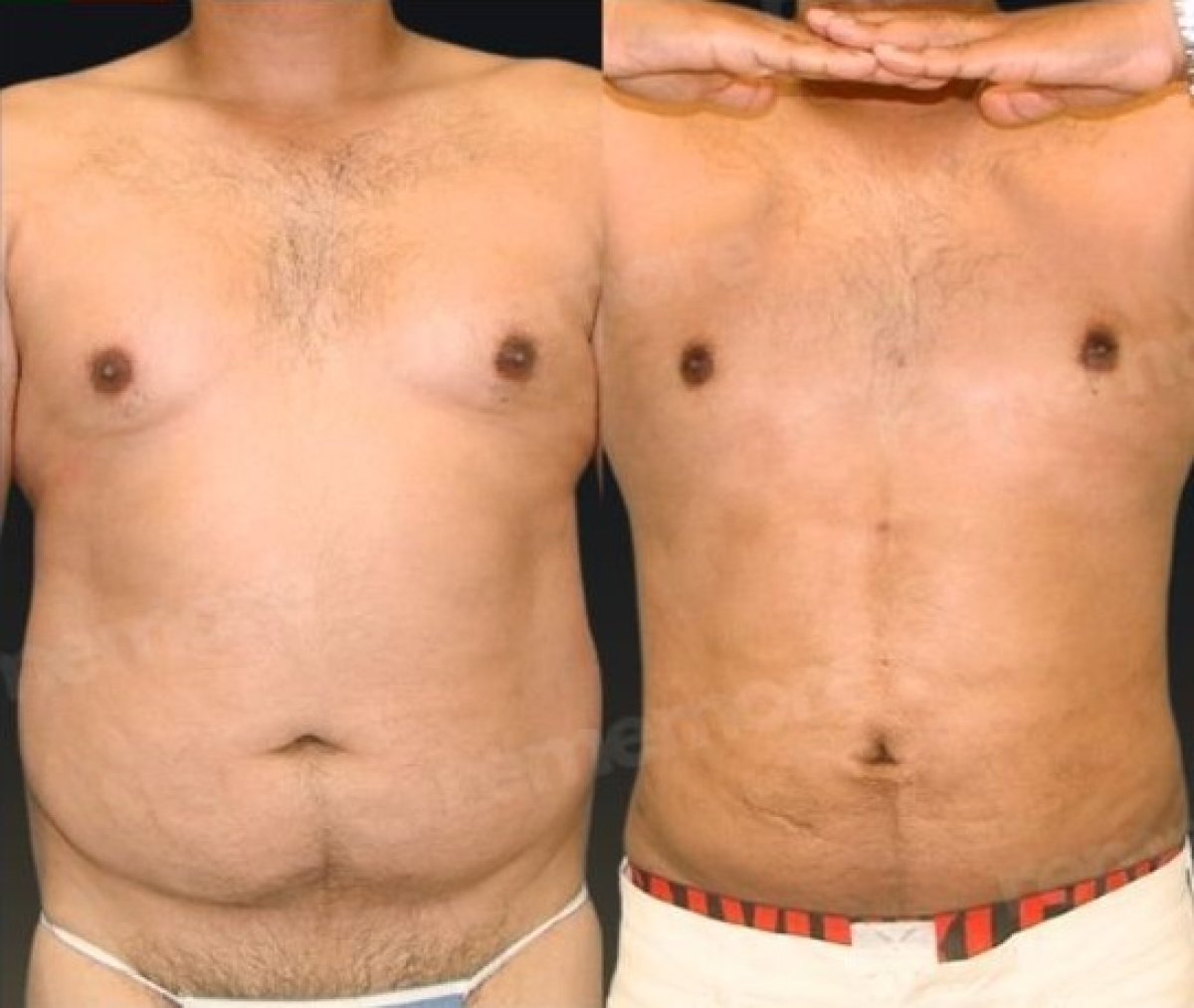 Before and after 360 liposuction results at Memorial Şişli Hospital, improved body contour