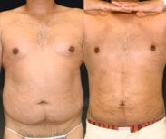 Resultados de liposucción 360 antes y después en Memorial Şişli Hospital, contorno mejorado