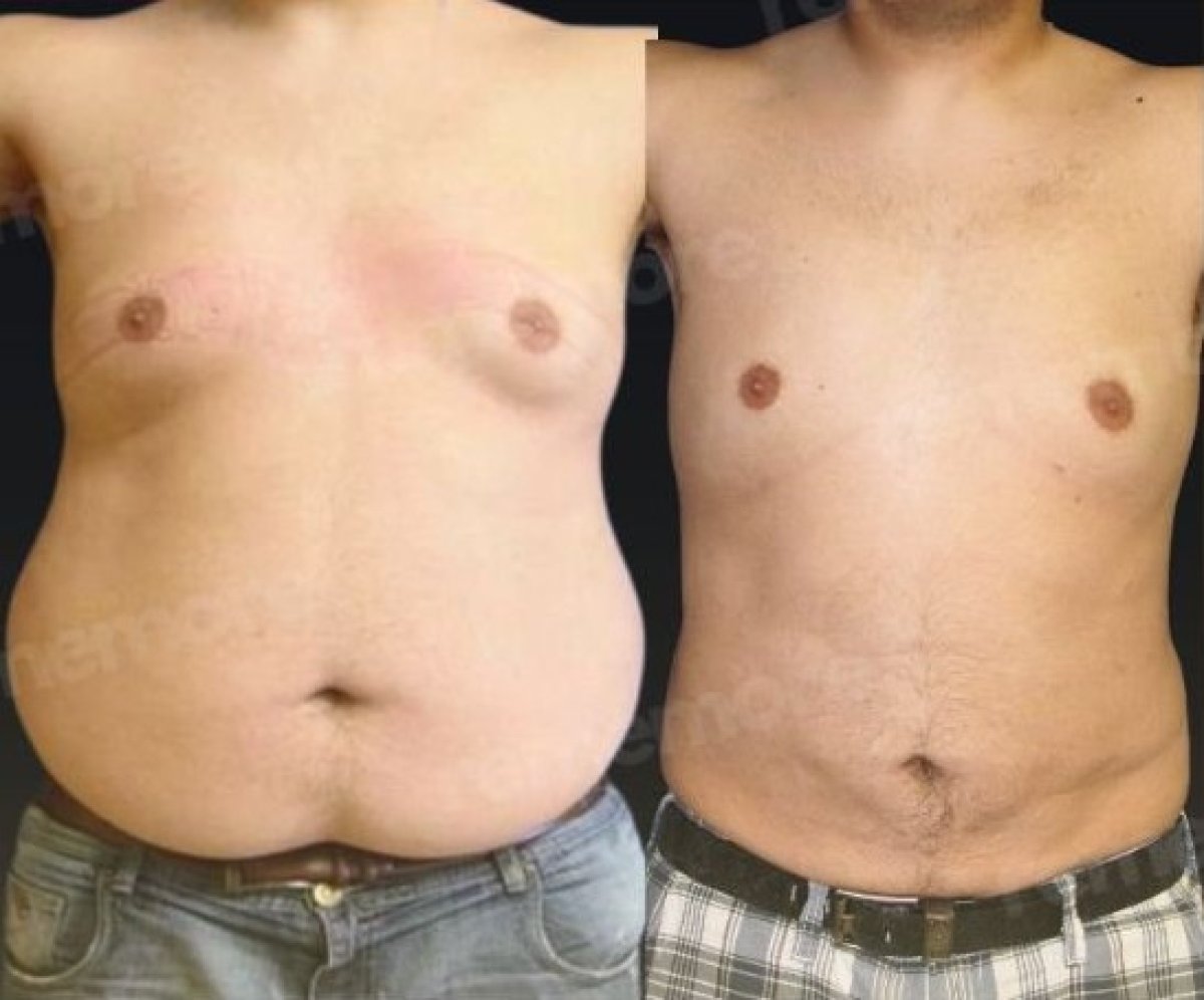 Before and after 360 liposuction results at Memorial Şişli Hospital, improved body contour