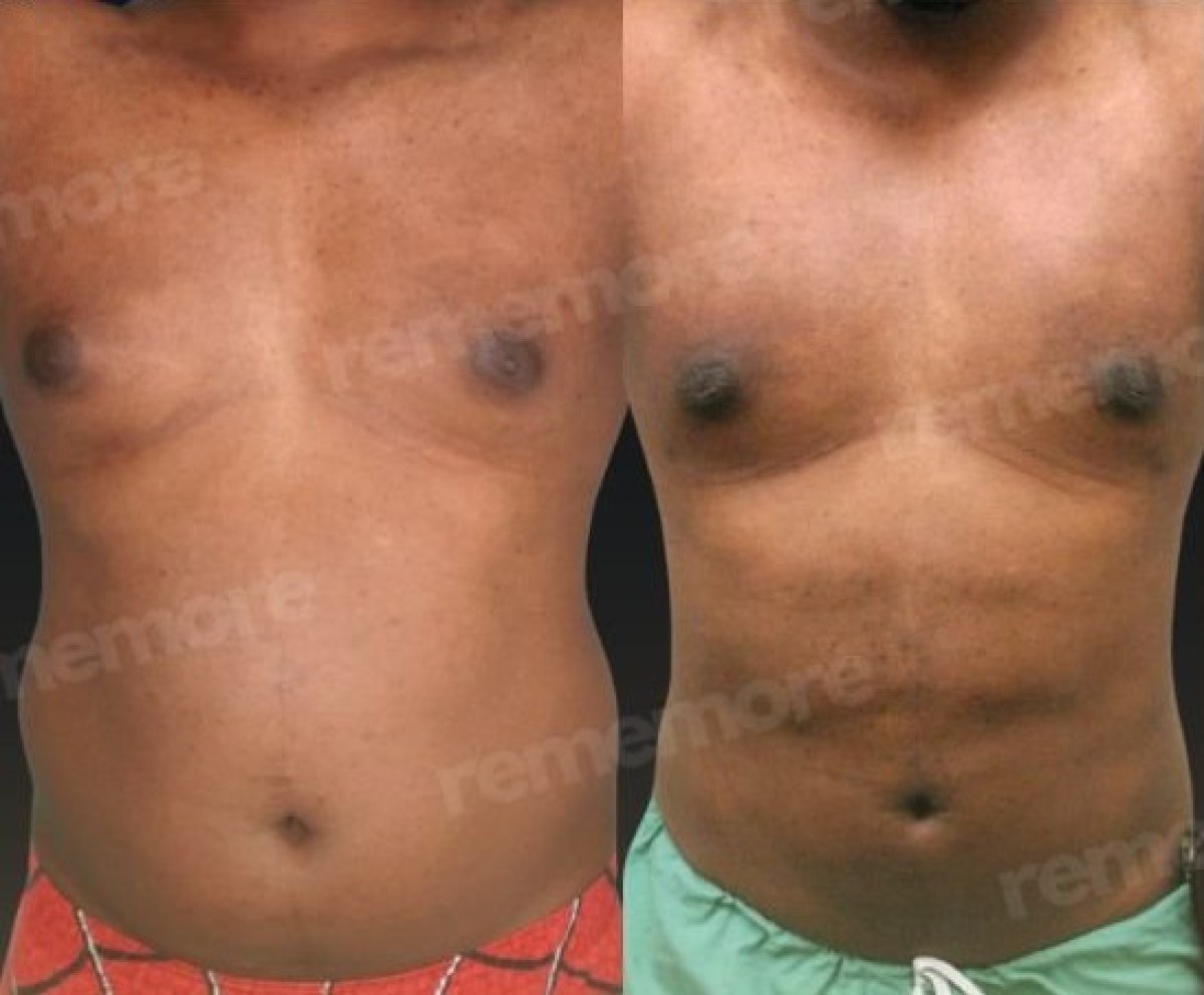 360 liposuction before and after results at Memorial Şişli Hospital, improved body contour