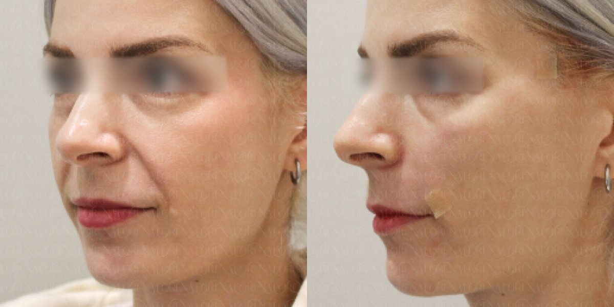 Resultados antes y después de lifting con hilos en Forena Clinic, mejora del contorno facial