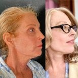 Before and after deep plane facelift results at Marroquín & Sandoval Plastic Surgery Clinic