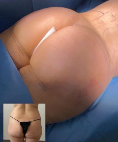 Vorher-nachher-Ergebnis Brazilian Butt Lift bei Dr. Safa Manav Clinic, verbesserte Gesäßkontur