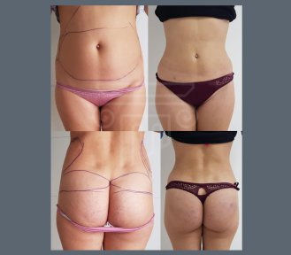 Vorher-nachher-Ergebnis Brazilian Butt Lift bei Dr. Safa Manav Clinic, verbesserte Körperform