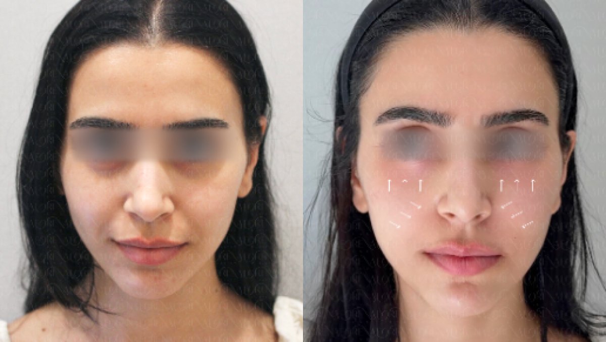 Результати омолодження шкіри до і після у Forena Clinic, покращення текстури обличчя