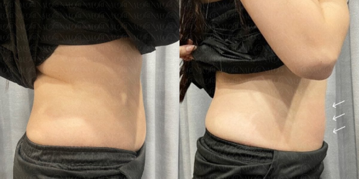 Результаты до и после контурирования тела BodyTite в Forena Clinic, видимое уменьшение талии