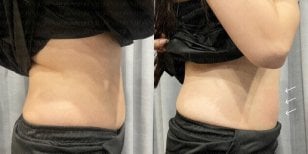 Before and after BodyTite body contouring results at Forena Clinic, visible waist slimming