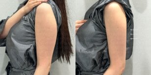 Before and after BodyTite body contouring result at Forena Clinic, improved arm shape