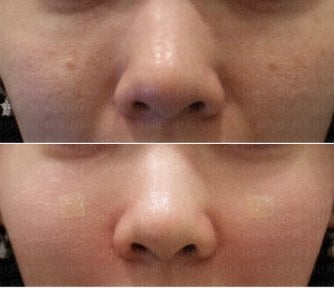 Resultados antes y después de terapia de rejuvenecimiento con células madre en Forena Clinic