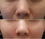 Resultados antes y después de terapia de rejuvenecimiento con células madre en Forena Clinic