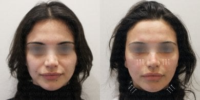 Результаты термажа лица до и после в Forena Clinic – видимый эффект подтяжки кожи