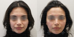 Результаты термажа лица до и после в Forena Clinic – видимый эффект подтяжки кожи