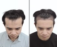 نتائج زراعة الشعر قبل وبعد في عيادة Dr.Nutt، استعادة خط الشعر الأمامي