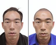 نتائج زراعة الشعر قبل وبعد في عيادة Dr.Nutt، خط شعر وكثافة محسنة