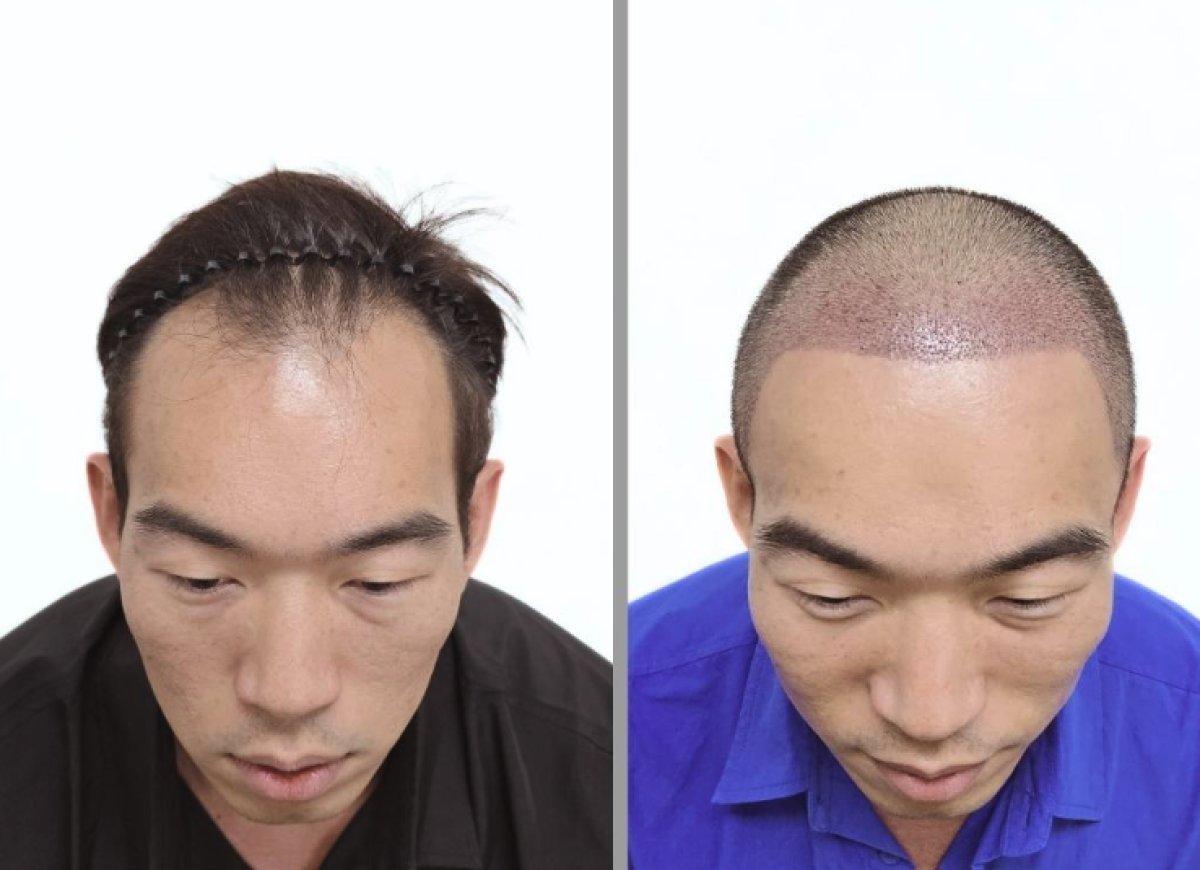 Vorher-nachher-Ergebnis Haartransplantation bei Dr.Nutt Clinic, wiederhergestellter Haaransatz