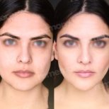 Before and after cheekbone reduction results at Memorial Şişli Hospital, facial contouring