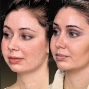 Before and after cheekbone reduction results at Memorial Şişli Hospital, facial contouring