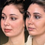 Before and after cheekbone reduction results at Memorial Şişli Hospital, facial contouring