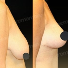 Resultados antes y después de mastopexia en Memorial Bahçelievler Hospital, mejor contorno