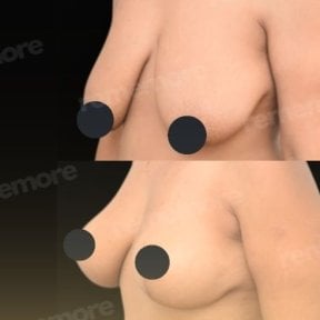 Resultados de lifting de senos antes y después en Memorial Bahçelievler Hospital, mejor contorno