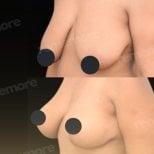 Resultados de lifting de senos antes y después en Memorial Bahçelievler Hospital, mejor contorno