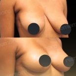 Resultados antes y después de mastopexia en Memorial Bahçelievler Hospital, contorno firme