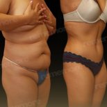 Before and after back liposuction results at Memorial Antalya Hospital, improved body contour