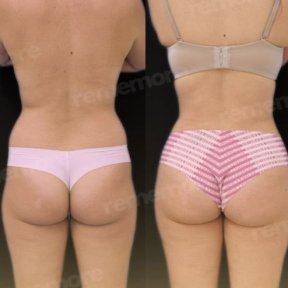 Before and after back liposuction results at Memorial Antalya Hospital, improved body contour