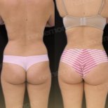 Before and after back liposuction results at Memorial Antalya Hospital, improved body contour