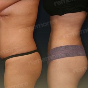 Before and after back liposuction results at Memorial Antalya Hospital, improved body contour