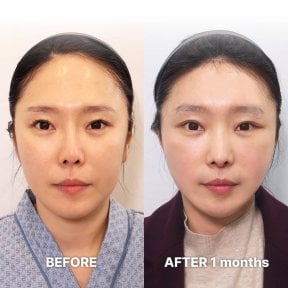 Результаты до и после deep plane SMAS лифтинга в Returning Plastic Surgery, омоложение лица