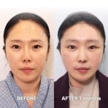 Результаты до и после deep plane SMAS лифтинга в Returning Plastic Surgery, омоложение лица