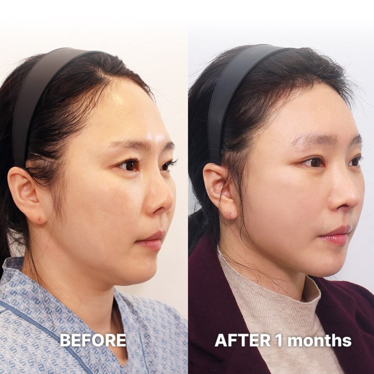 Resultados antes y después de deep plane facelift en Returning Plastic Surgery, lifting visible