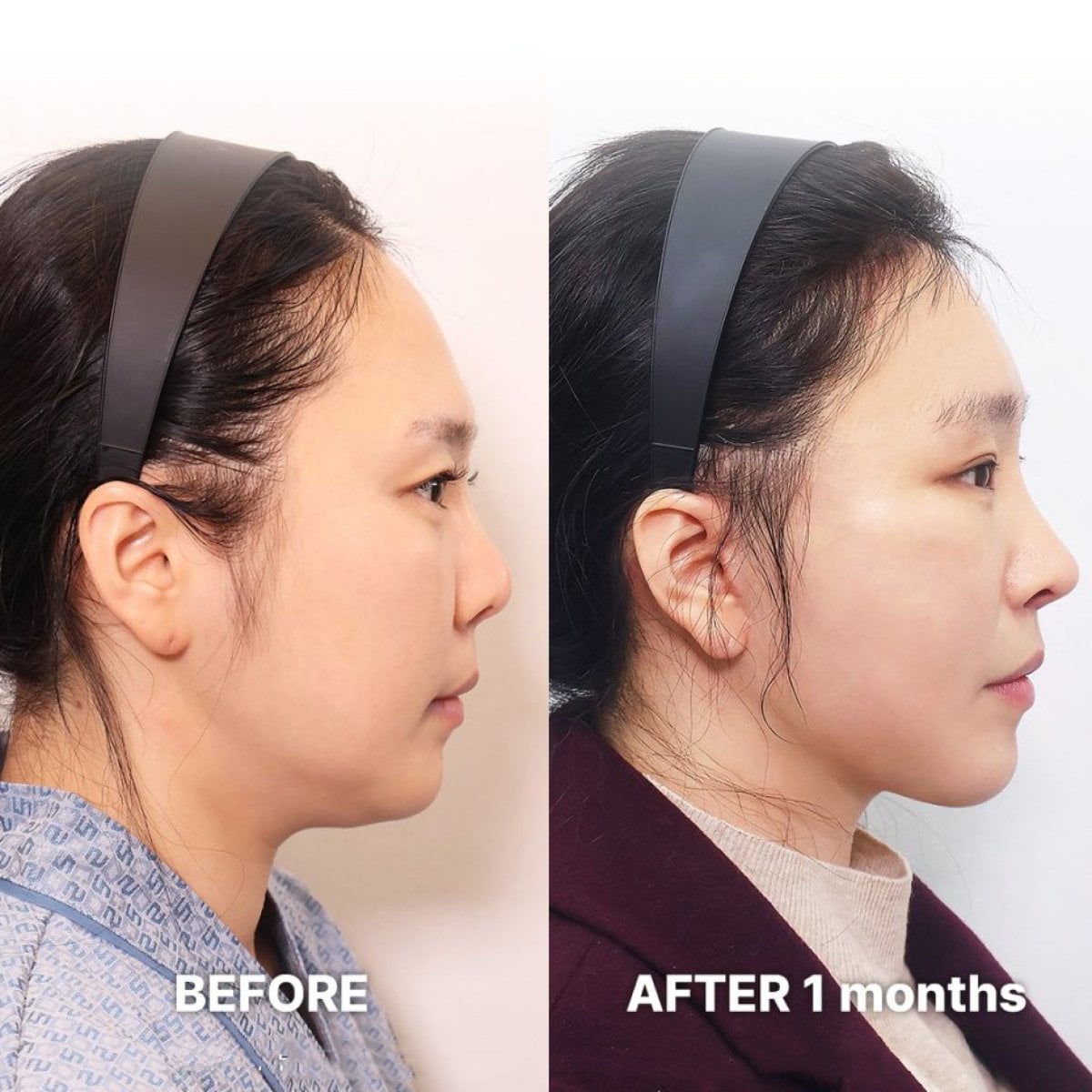 Resultados antes y después de deep plane facelift en Returning Plastic Surgery, contorno facial visible