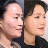 Результаты до и после deep plane SMAS лифтинга в Returning Plastic Surgery, омоложение лица