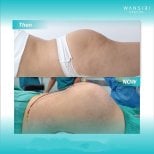 Before and after lipofilling (fat grafting) buttock enhancement results at Wansiri Hospital