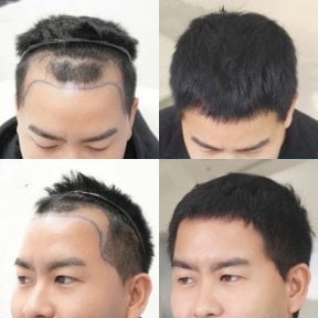Before and after hair transplant results at Wansiri Hospital, restored hairline and density