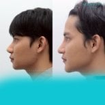 Before and after facial masculinization surgery results at Wansiri Hospital, jawline enhancement